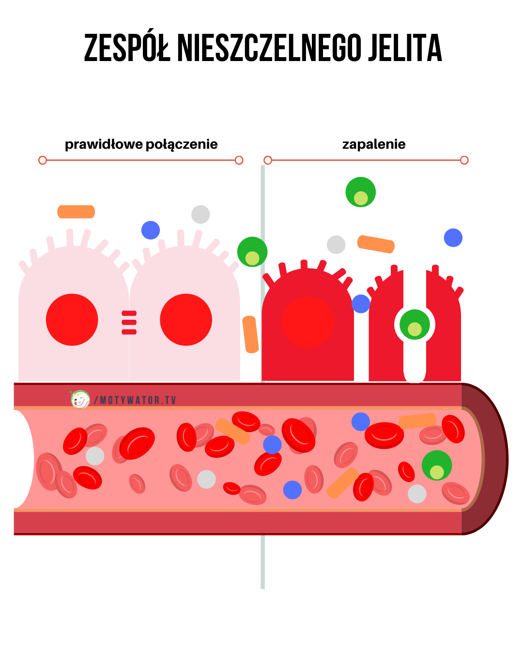 Zespół nieszczelnego jelita - część 1
