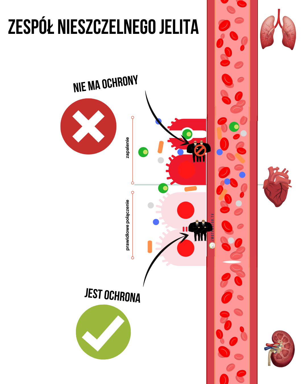 Zespół nieszczelnego jelita - część 3